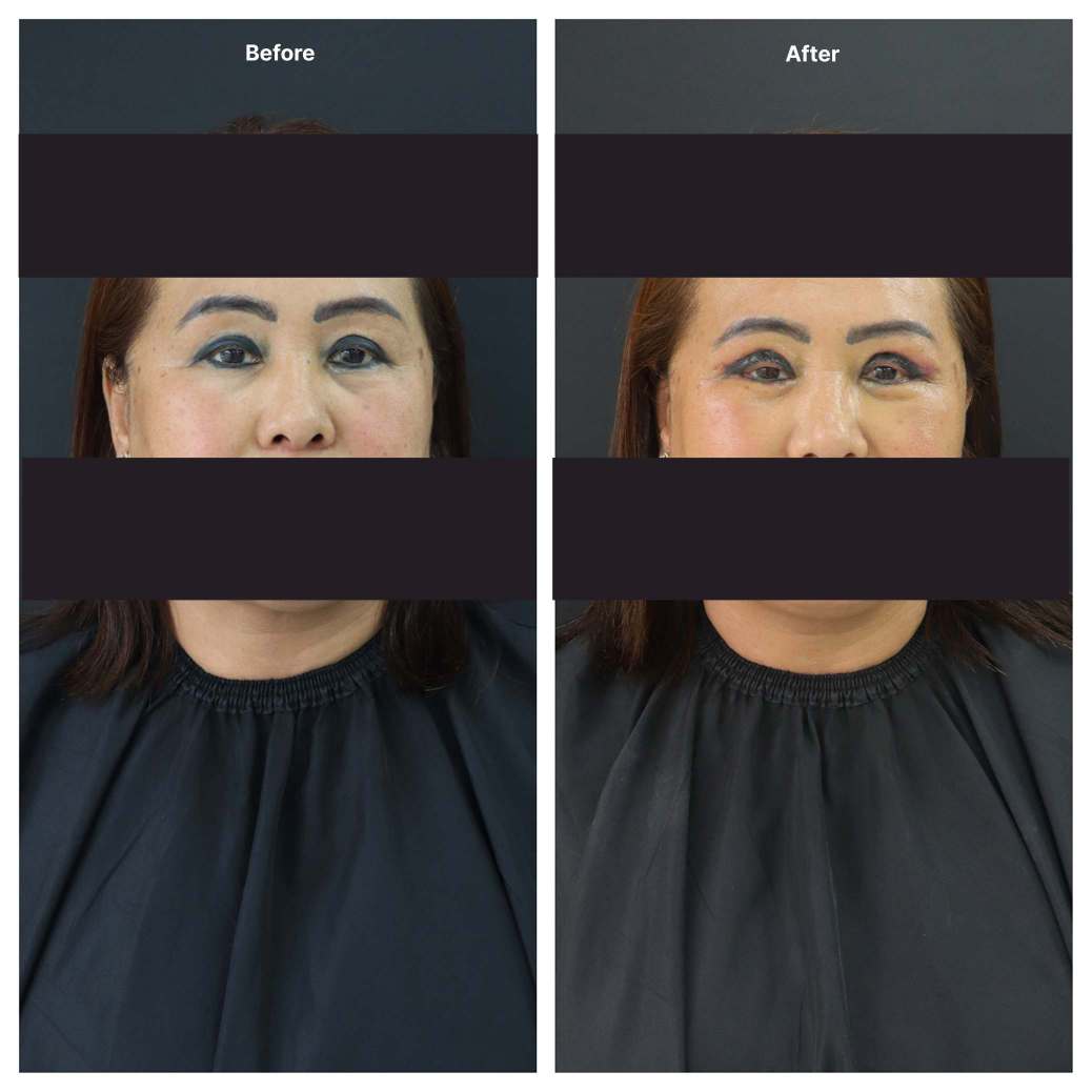 Eyelid Surgery KOQ10